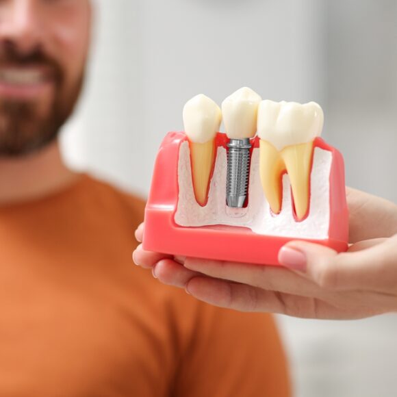 Navigating Your Journey to Dental Implants