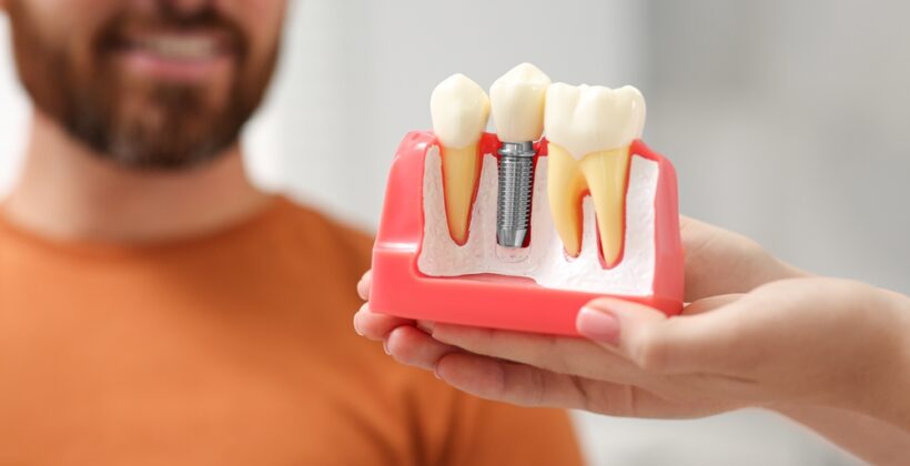 Navigating Your Journey to Dental Implants